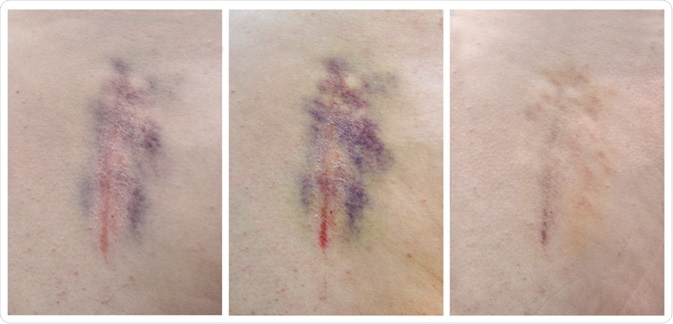 Color Change on Bruise Color Change on Bruise