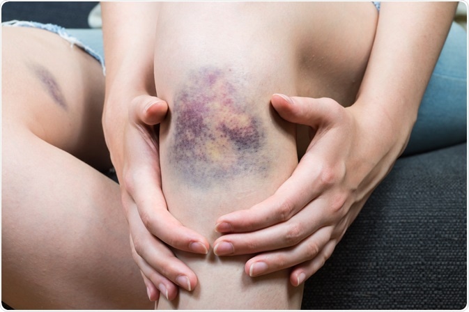 Bruises Bruises