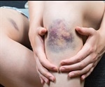 Aging Bruises using Spectroscopy