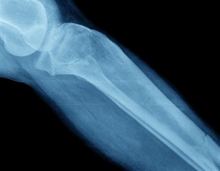 Loss of enzymatic processes can increase the risk of bone fracture