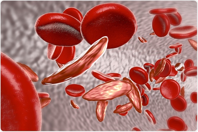 Sickle Cell Anemia Sickle Cell Anemia