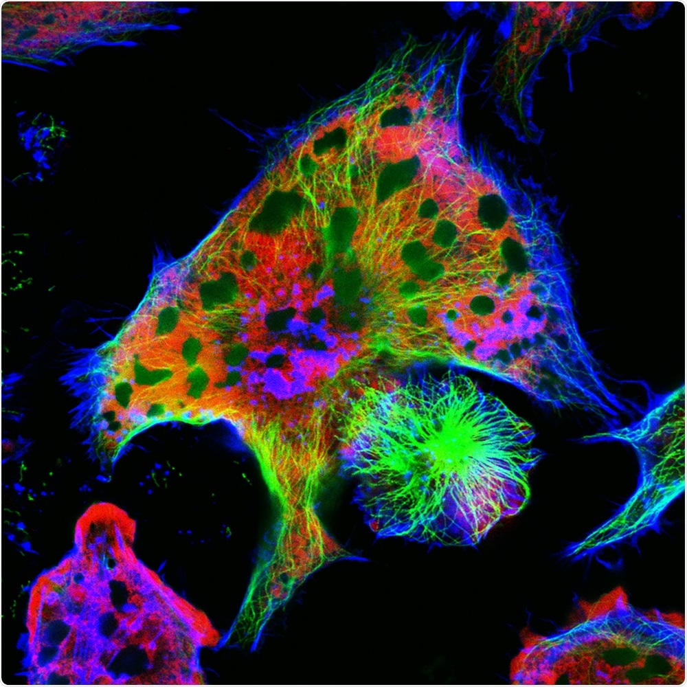 neuroblastoma neuroblastoma