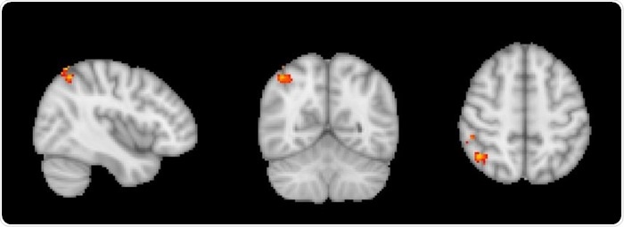 Researchers discover that existing drug can enhance memory