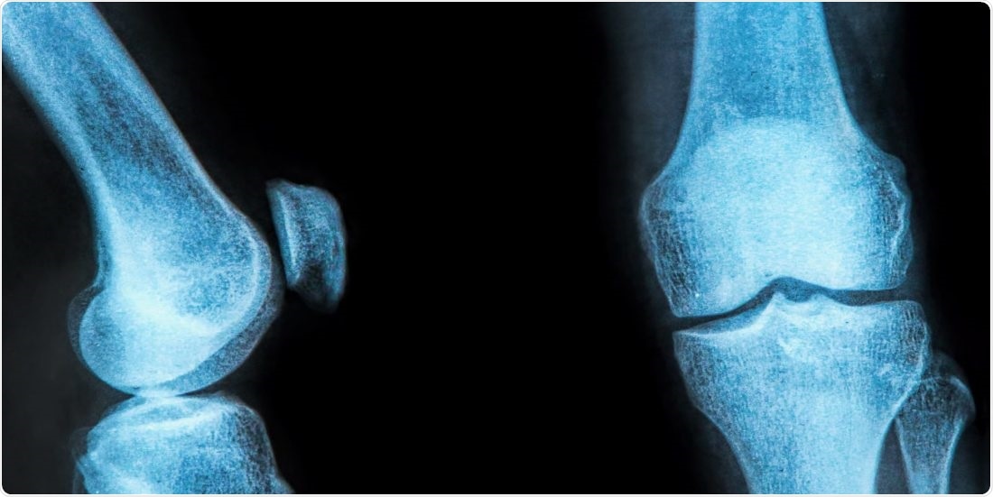 Study identifies genes involved in people with osteoarthritis