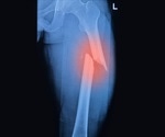Mesenchymal stem cells with enhanced fracture healing abilities identified