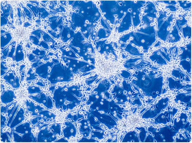Glioblastoma brain cells Glioblastoma brain cells