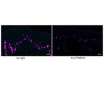 Study identifies key proteins that damage skin cells in psoriasis
