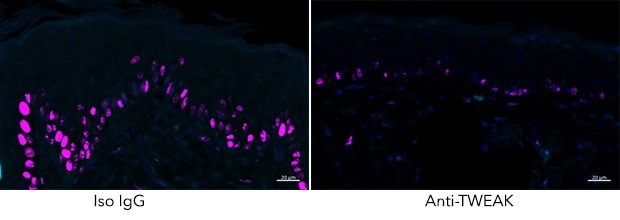 Study identifies key proteins that damage skin cells in psoriasis