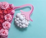 Study identifies new variants for polycystic ovary syndrome