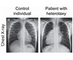Study unravels novel gene vital for establishing proper left-right asymmetry