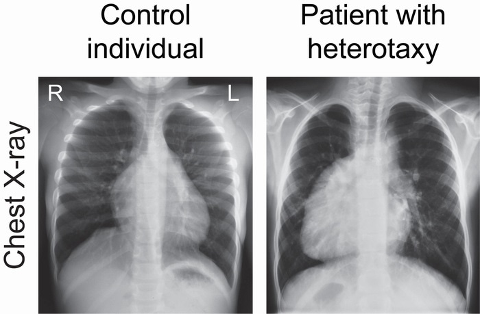 Study unravels novel gene vital for establishing proper left-right asymmetry