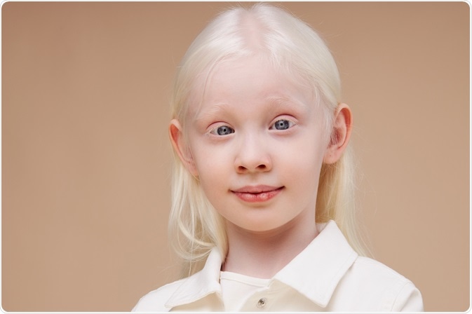 Albinism Albinism
