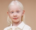 Genetics of Albinism