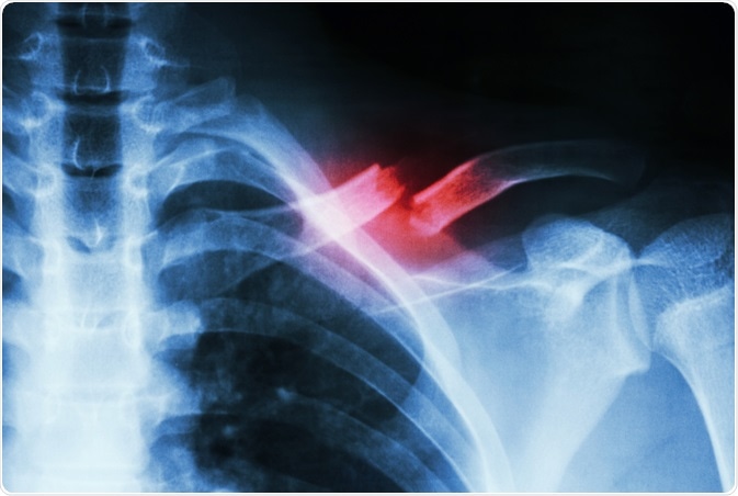 Broken Bone Broken Bone
