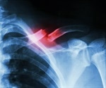 Creating Biomaterials that can Heal bone