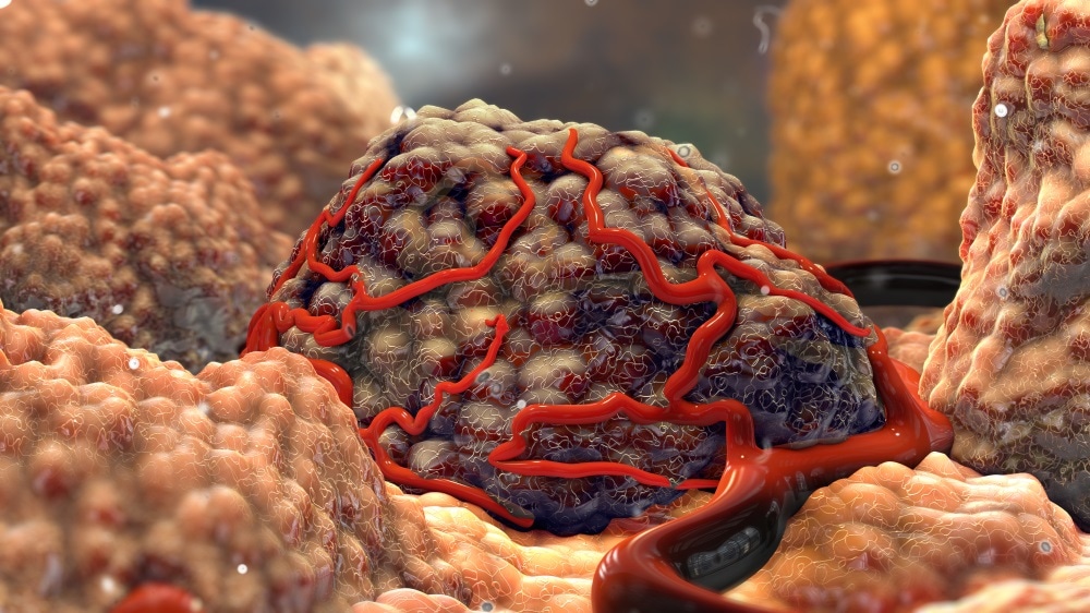 tumor microenvironment tumor microenvironment