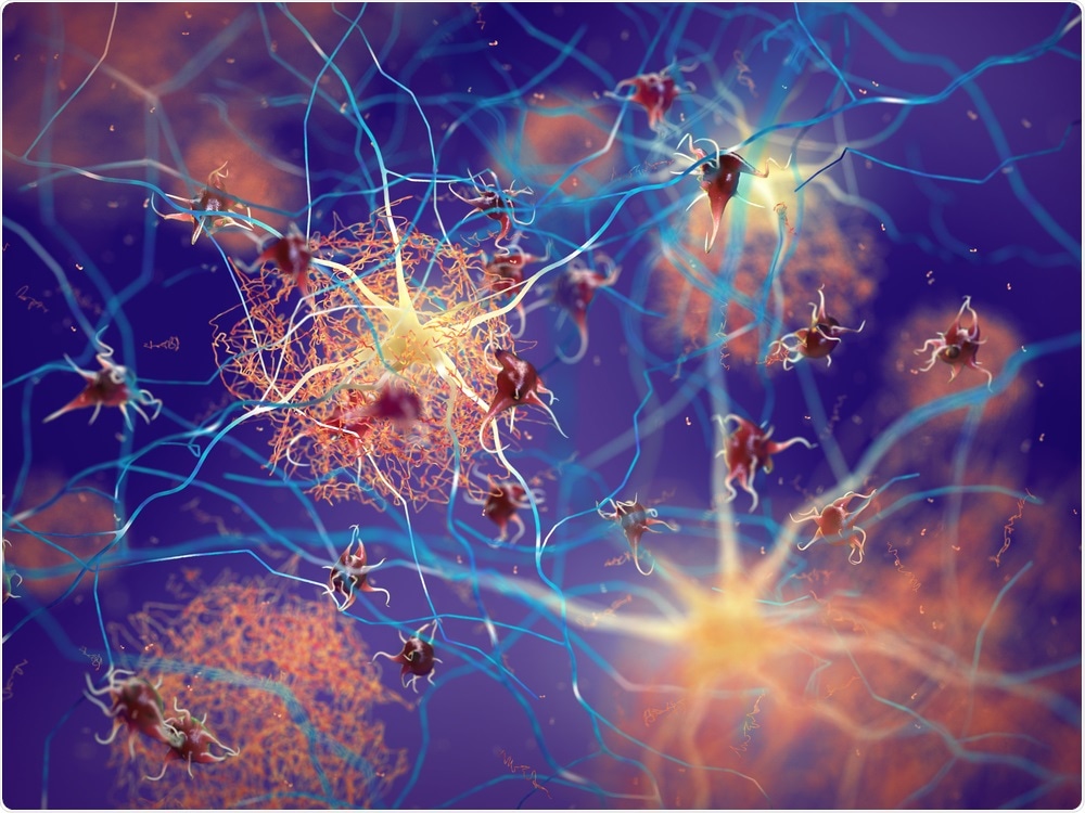 Amyloid Plaque Amyloid Plaque
