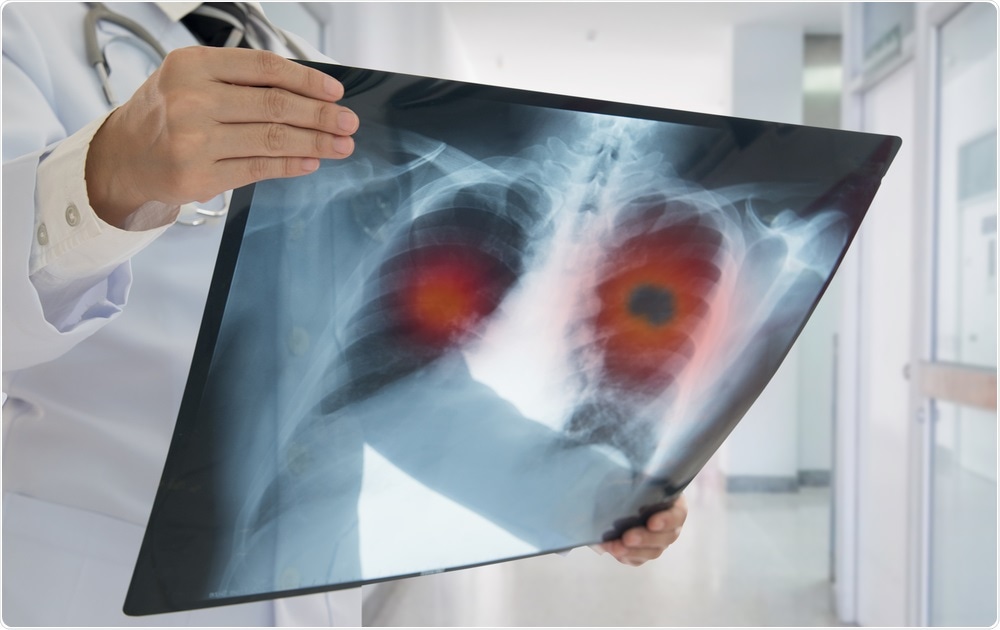 Lung Cancer Lung Cancer