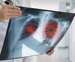 Presence of microbes in the lung can modulate lung cancer pathogenesis