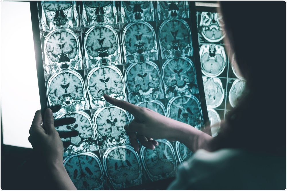 Alzheimers Disease Alzheimers Disease