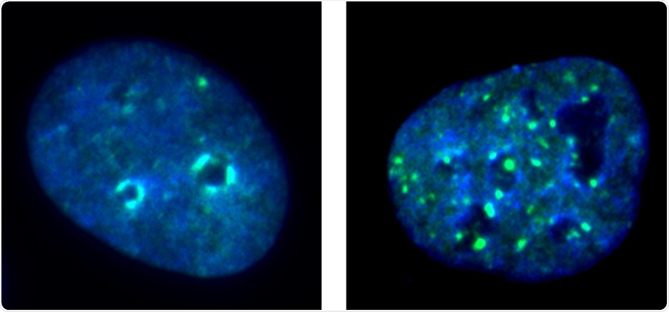 Specific enzyme can delay the growth and spread of neck and head carcinomas