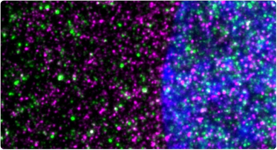 Mutant proteins plays key role in Huntington’s disease