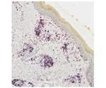Study shows how a subset of T cells is generated in melanoma survivors affected by vitiligo
