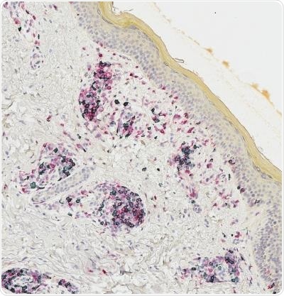 Study shows how a subset of T cells is generated in melanoma survivors affected by vitiligo