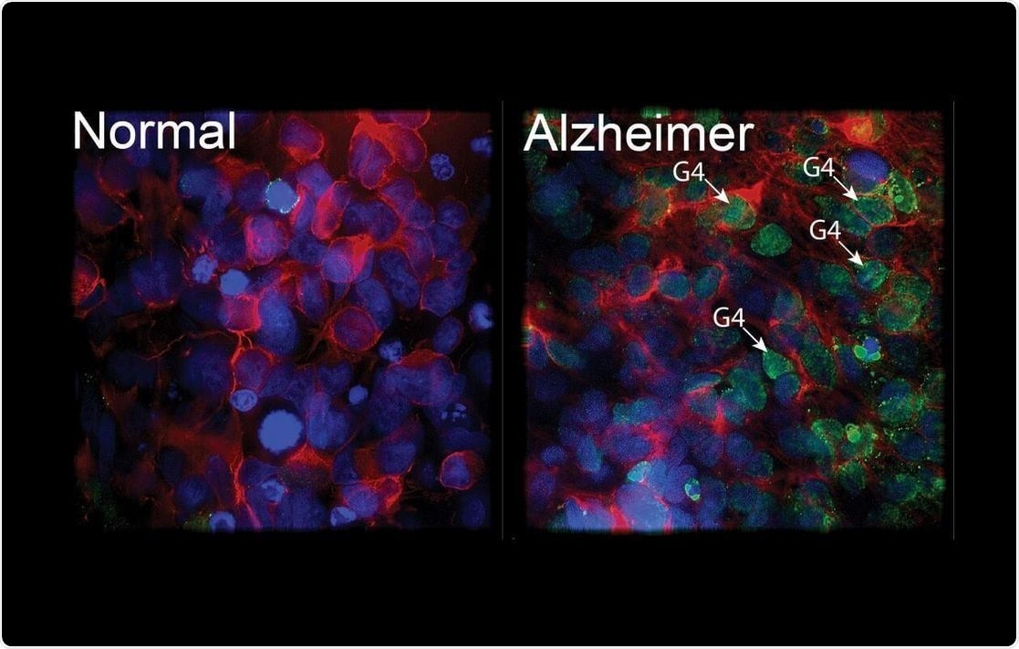 New function of BMI1 gene can protect against Alzheimer’s disease