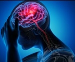New genetic evidence points to novel therapies for “silent” stroke