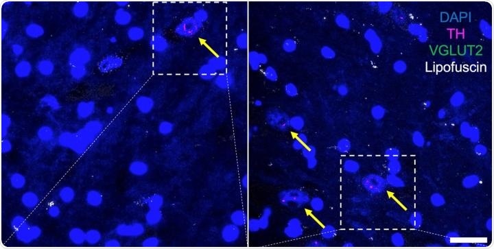 Study identifies single protein key to regulating sex differences in Parkinson’s disease