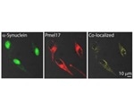 Study finds an amyloid link between melanoma and Parkinson’s disease