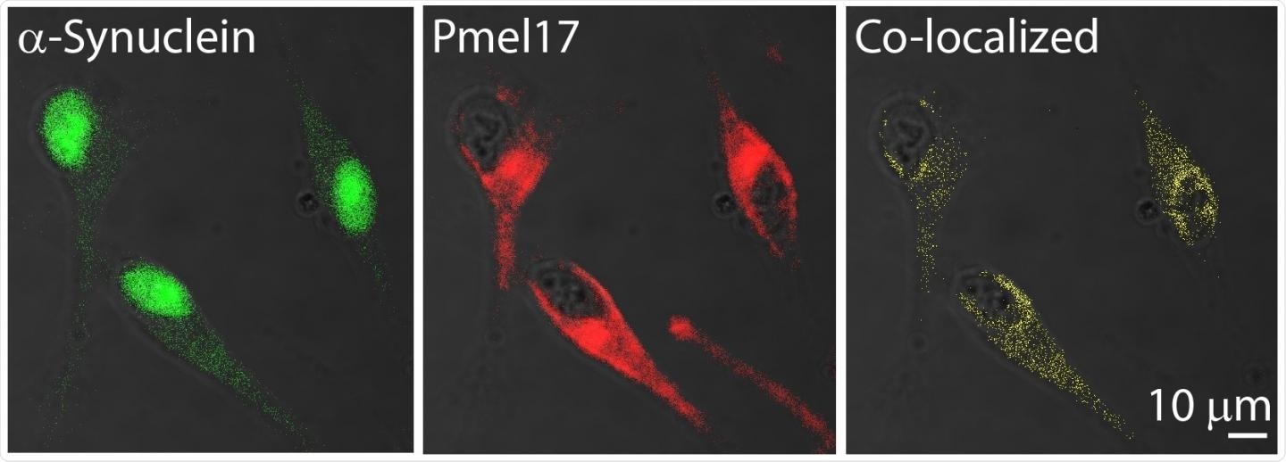 Study finds an amyloid link between melanoma and Parkinson’s disease