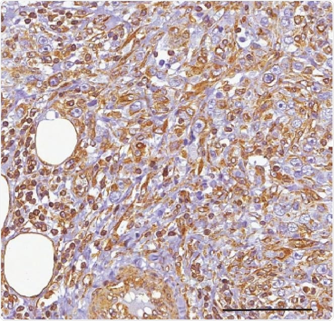 Study identifies a pair of microRNA molecules that maintain the population of cancerous stem cells