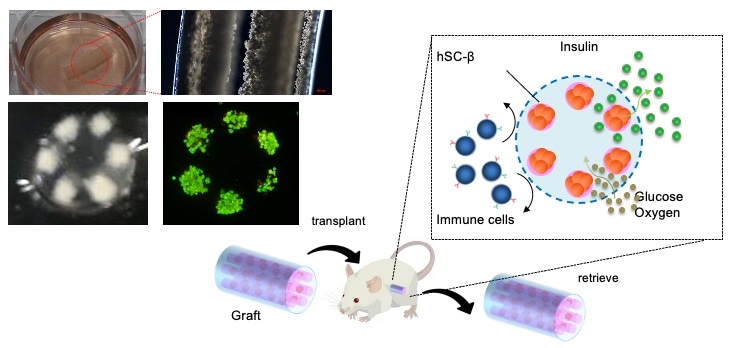 Novel device can help treat type I diabetes mellitus