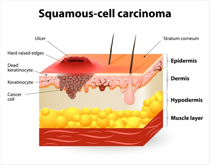 Squamous-cell Carcinoma Squamous-cell Carcinoma