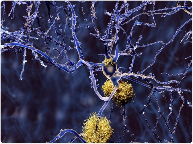 Alzheimers Disease Alzheimers Disease