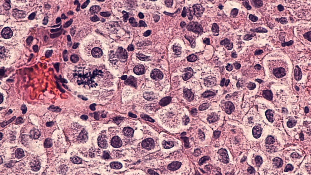 melanoma