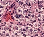Customized tumor cell vaccine produces active immune response in melanoma, neuroblastoma models