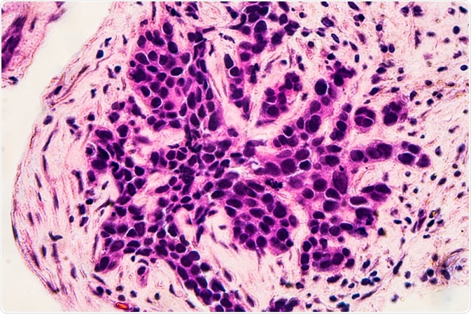 Breast Cancer Cells Breast Cancer Cells
