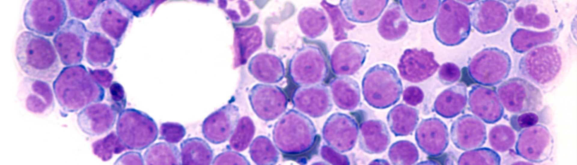 New therapeutic target for patients with acute myeloid leukemia