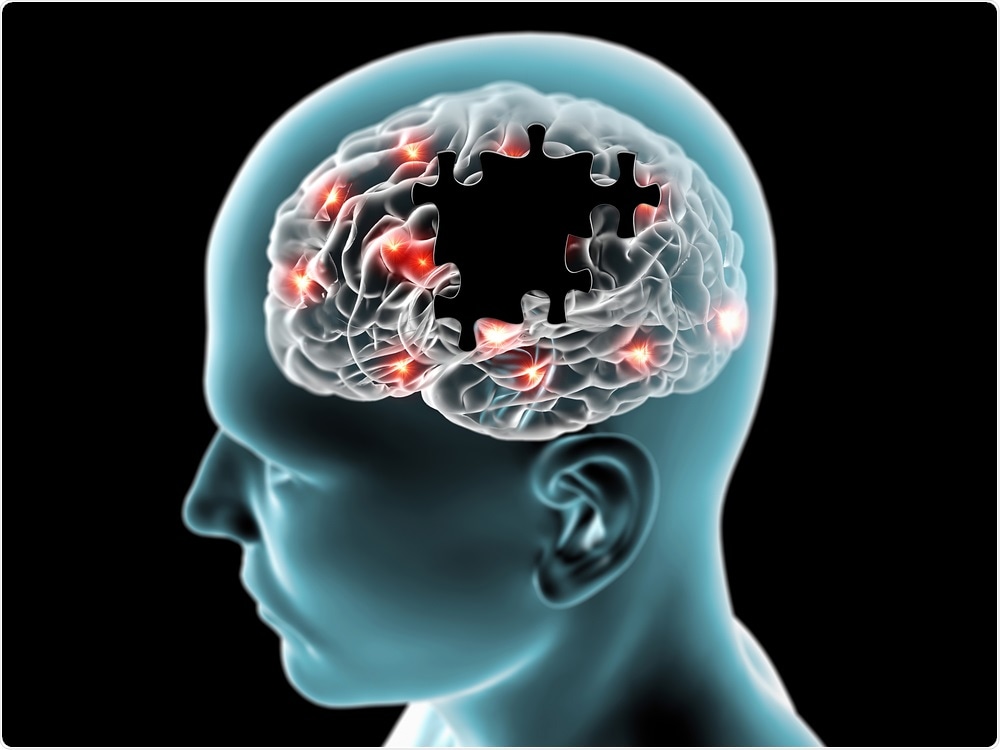 Alzheimers Disease Alzheimers Disease