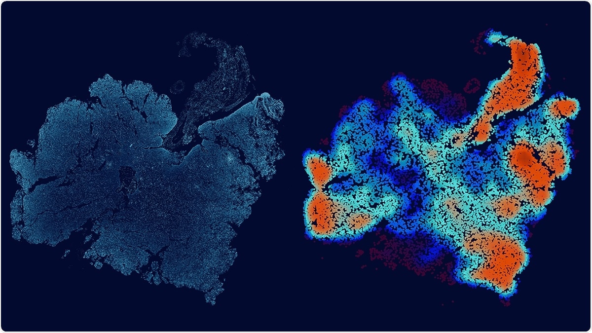 New method can improve the efficacy of promising treatment for recurrent glioblastoma