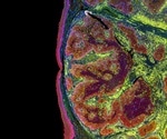 Study reveals mechanisms promoting overall glioma tumor growth