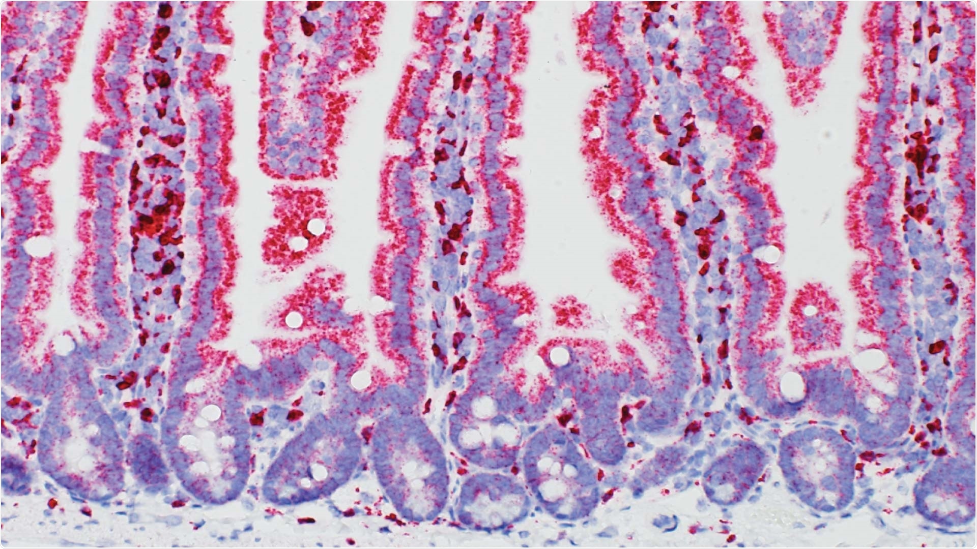 Study reports high-fat diet increases the incidence of colorectal cancer