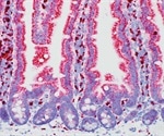 Study reports high-fat diet increases the incidence of colorectal cancer