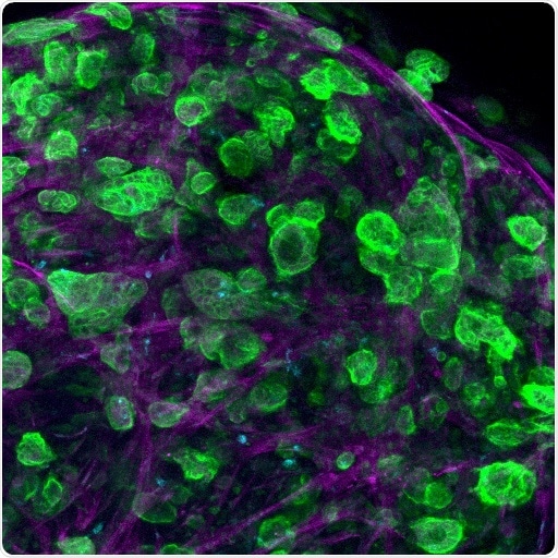 Scientists create a three-dimensional pancreatic cancer tumor model