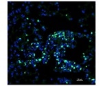 Eosinophils combat cancer metastases in the lungs, says research