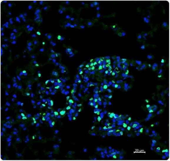 Eosinophils combat cancer metastases in the lungs, says research
