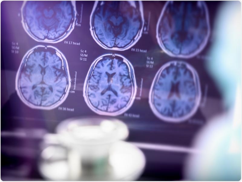 Healthy sleep pattern alleviates some of the symptoms of Alzheimer’s disease